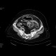 Peritonitis, perforation of large bowel: CT - Computed tomography